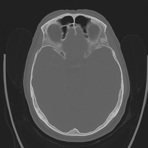 File:Chondrosarcoma of skull base- grade II (Radiopaedia 40948-43653 Axial bone window 18).png