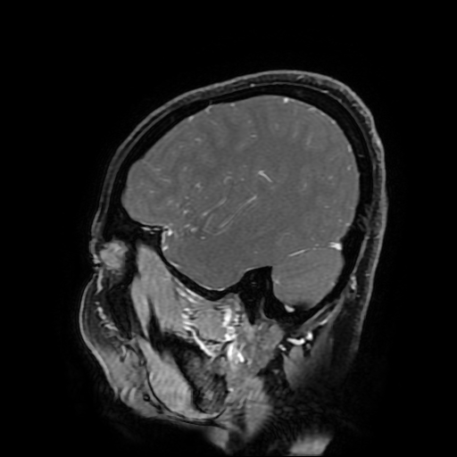 Chordoid glioma of third ventricle (Radiopaedia 91612-109340 F 160).jpg