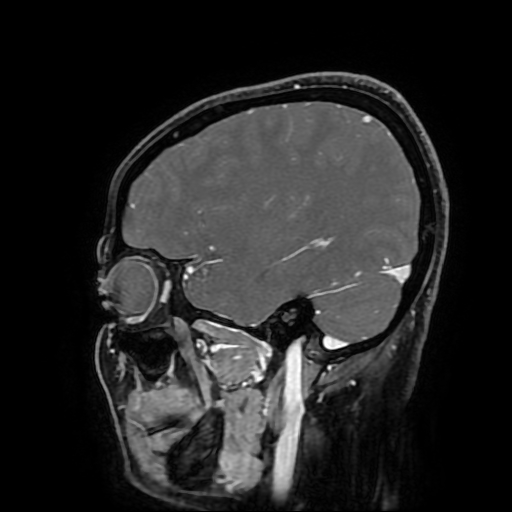Chordoid glioma of third ventricle (Radiopaedia 91612-109340 F 63).jpg