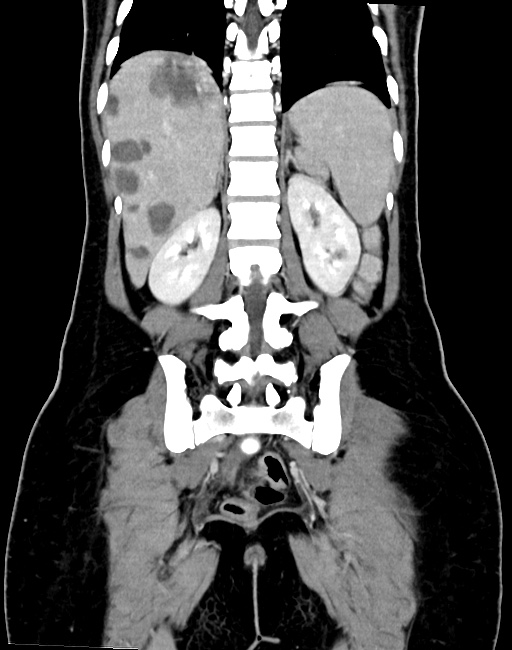Choriocarcinoma liver metastases (Radiopaedia 74768-85766 B 73).jpg