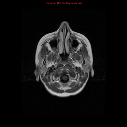 File:Choroid plexus carcinoma - recurrent (Radiopaedia 8330-9169 Axial T1 C+ 1).jpg