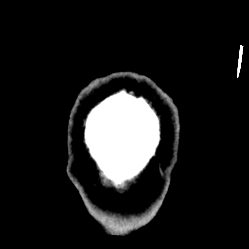 Choroid plexus papilloma (Radiopaedia 34951-36436 Coronal non-contrast 65).png