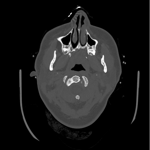 Choroid plexus papilloma extending into the cerebellopontine angle cistern (Radiopaedia 85941-101833 Axial bone window 7).png