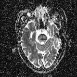 Choroid plexus xanthogranuloma - unilateral (Radiopaedia 85632-101393 Axial ADC 20).jpg