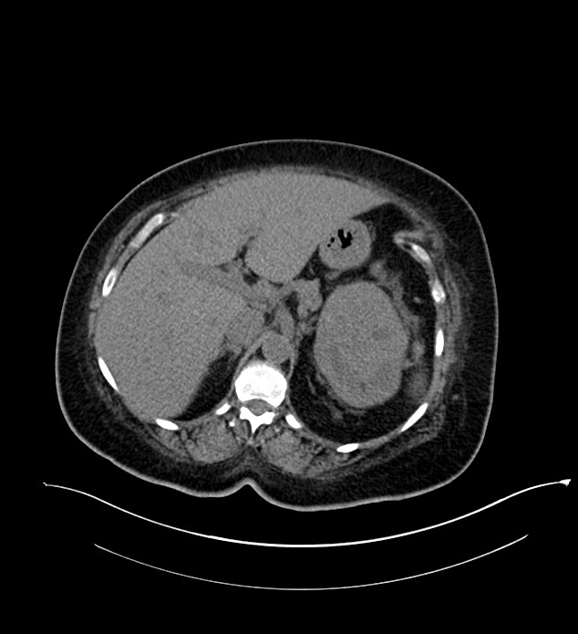 Chromophobe renal cell carcinoma (Radiopaedia 84239-99519 Axial non-contrast 54).jpg