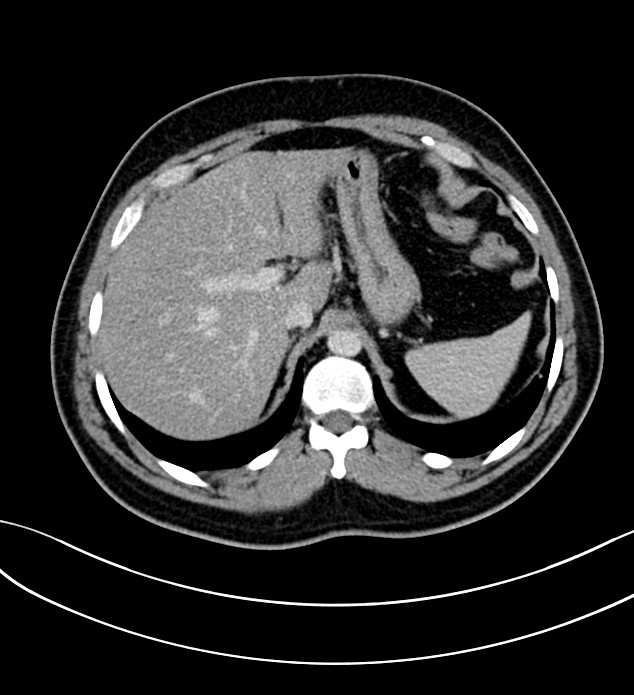 Chromophobe renal cell carcinoma (Radiopaedia 84286-99573 G 13).jpg