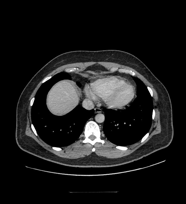 Chromophobe renal cell carcinoma (Radiopaedia 84337-99644 C 12).jpg