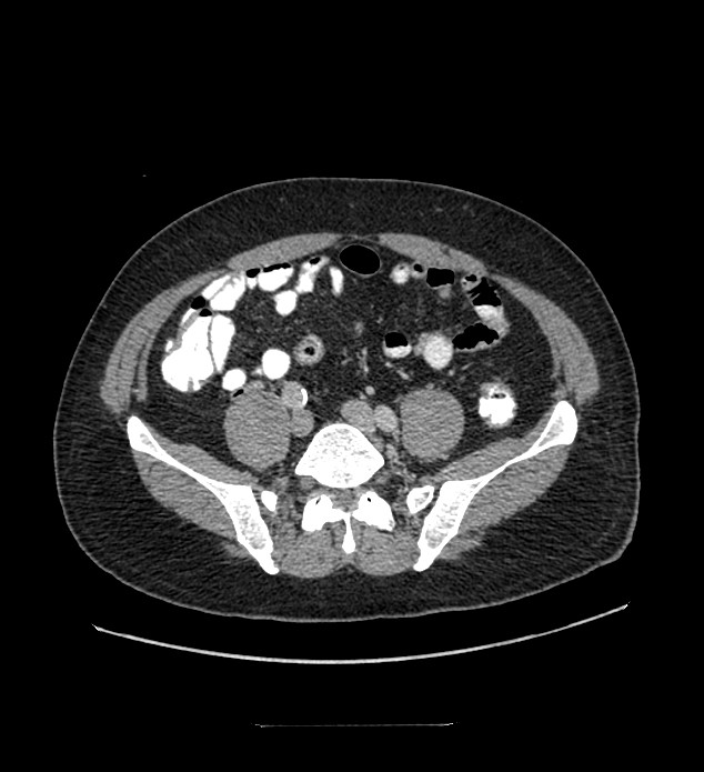 Chromophobe renal cell carcinoma (Radiopaedia 84337-99644 C 93).jpg