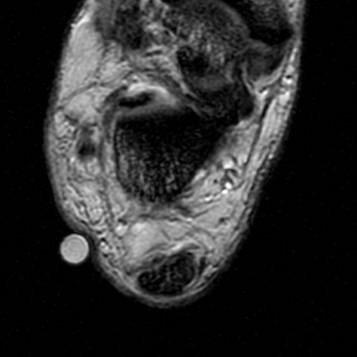 File:Chronic Achilles tendon rupture (Radiopaedia 15262-15100 Axial Gradient Echo 19).jpg