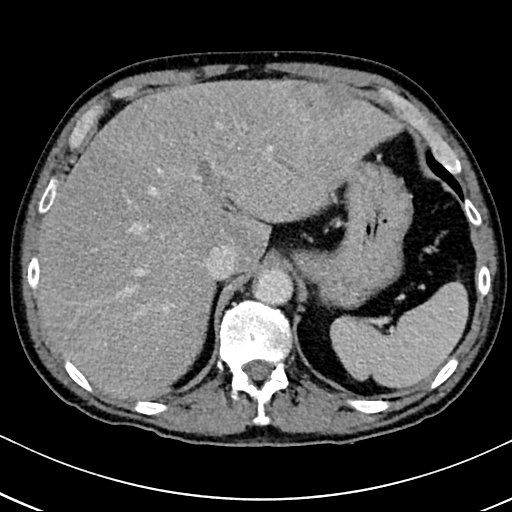 Chronic appendicitis complicated by appendicular abscess, pylephlebitis and liver abscess (Radiopaedia 54483-60700 B 39).jpg