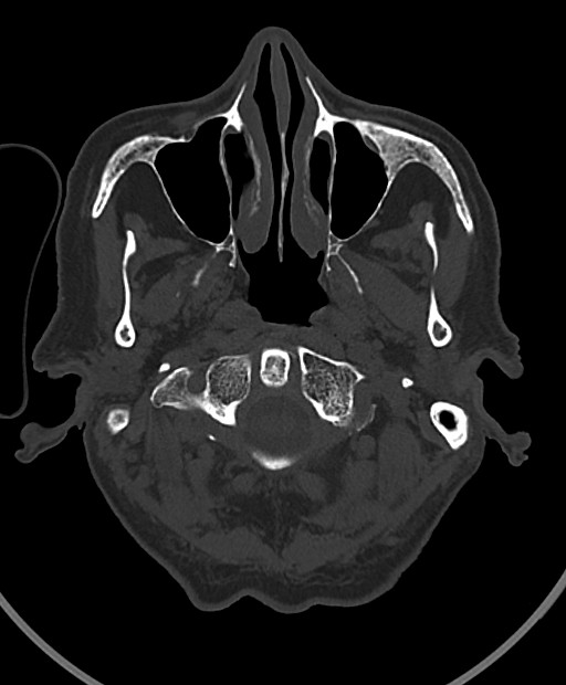 Chronic bilateral subdural hygroma (Radiopaedia 85801-101623 Axial bone window 111).jpg