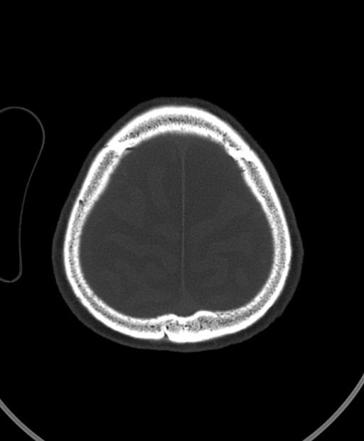 Chronic bilateral subdural hygroma (Radiopaedia 85801-101623 Axial bone window 26).jpg