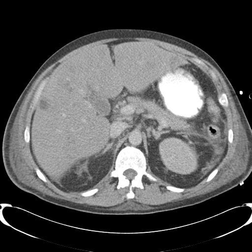 Chronic diverticulitis complicated by hepatic abscess and portal vein thrombosis (Radiopaedia 30301-30938 A 32).jpg