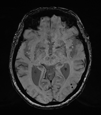 Chronic hypertensive encephalopathy (Radiopaedia 39993-42482 Axial SWI 40).png