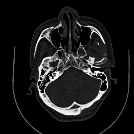 Chronic invasive fungal sinusitis (Radiopaedia 91563-109286 Axial sinus 34).jpg
