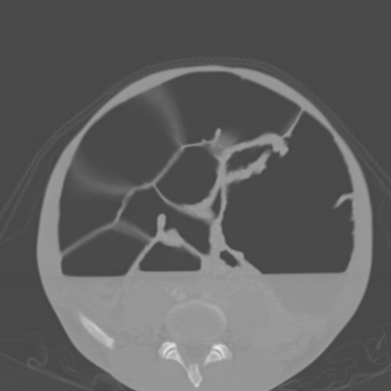 File:Chronic large bowel pseudo-obstruction (Radiopaedia 43181-46492 Axial bone window 116).jpg