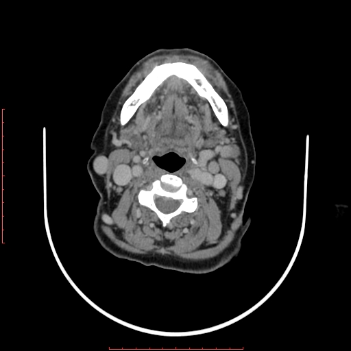 File:Chronic osteomyelitis - maxilla (Radiopaedia 23783-23927 B 8).jpg