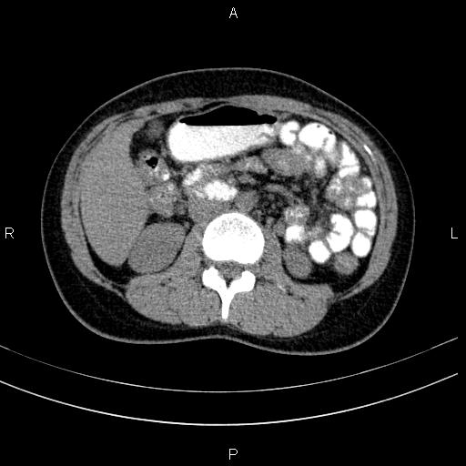 Chronic pancreatitis (Radiopaedia 64576-73450 Axial non-contrast 72).jpg