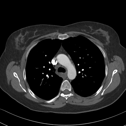 Chronic pulmonary embolus (Radiopaedia 39129-41341 Axial C+ CTPA 37).png