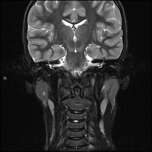 File:Chronic reactive multifocal osteomyelitis (CRMO) - mandible (Radiopaedia 56405-63069 Coronal STIR 23).jpg