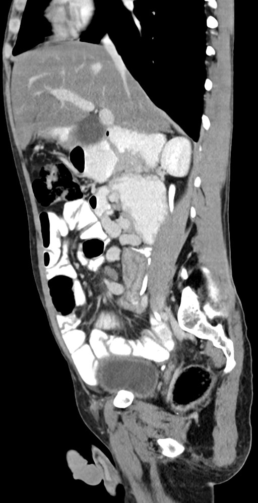 Chronic small bowel volvulus (Radiopaedia 75224-86322 C 91).jpg