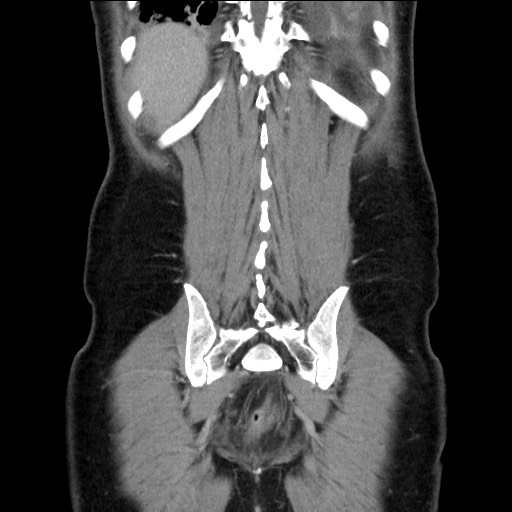 Chronic ureteropelvic junction obstruction (Radiopaedia 78365-90996 B 85).jpg