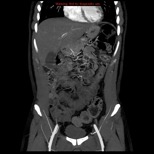 File:Circumaortic left renal vein (Radiopaedia 9069-9792 B 5).jpg
