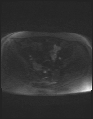Class II Mullerian duct anomaly- unicornuate uterus with rudimentary horn and non-communicating cavity (Radiopaedia 39441-41755 Axial DWI 76).jpg