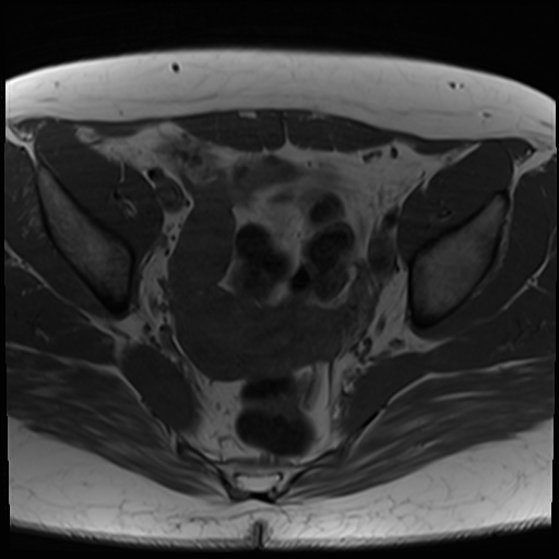 File:Class II Mullerian duct anomaly- unicornuate uterus with rudimentary horn and non-communicating cavity (Radiopaedia 39441-41755 Axial T1 15).jpg