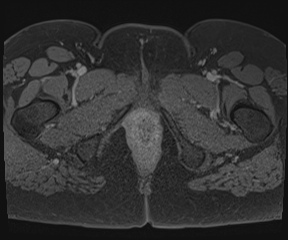 File:Class II Mullerian duct anomaly- unicornuate uterus with rudimentary horn and non-communicating cavity (Radiopaedia 39441-41755 Axial T1 fat sat 143).jpg