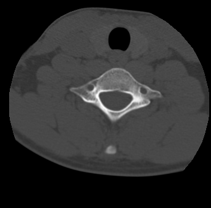 Clay-shoveler fracture (Radiopaedia 22568-22590 Axial bone window 59).jpg