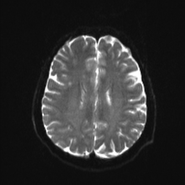 File:Clival meningioma (Radiopaedia 53278-59248 Axial DWI 17).jpg