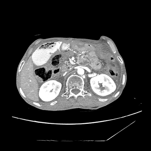 Closed-loop obstruction due to peritoneal seeding mimicking internal hernia after total gastrectomy (Radiopaedia 81897-95864 A 47).jpg