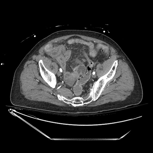 File:Closed loop obstruction due to adhesive band, resulting in small bowel ischemia and resection (Radiopaedia 83835-99023 B 126).jpg