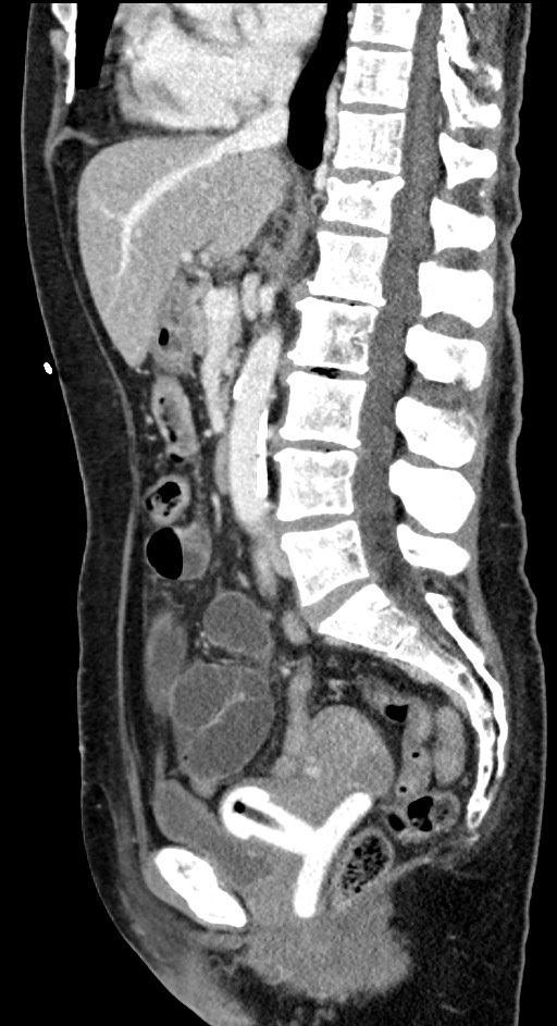 Closed loop small bowel obstruction - adhesive band with a C-shaped loop (Radiopaedia 83832-99018 C 65).jpg