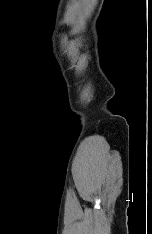 Closed loop small bowel obstruction - internal hernia (Radiopaedia 57806-64778 C 7).jpg