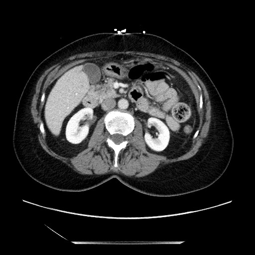File:Closed loop small bowel obstruction due to adhesive bands - early and late images (Radiopaedia 83830-99014 A 56).jpg