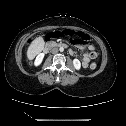 File:Closed loop small bowel obstruction due to adhesive bands - early and late images (Radiopaedia 83830-99014 A 66).jpg