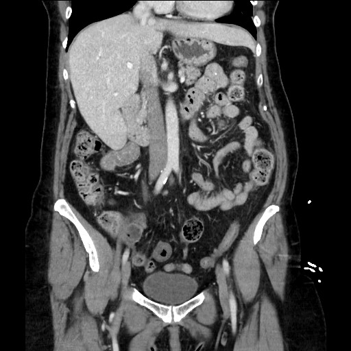Closed loop small bowel obstruction due to adhesive bands - early and late images (Radiopaedia 83830-99014 B 57).jpg