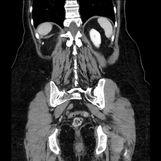 Closed loop small bowel obstruction due to adhesive bands - early and late images (Radiopaedia 83830-99014 B 98).jpg