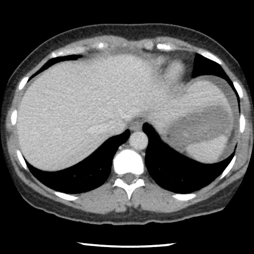 Closed loop small bowel obstruction due to trans-omental herniation (Radiopaedia 35593-37109 A 17).jpg