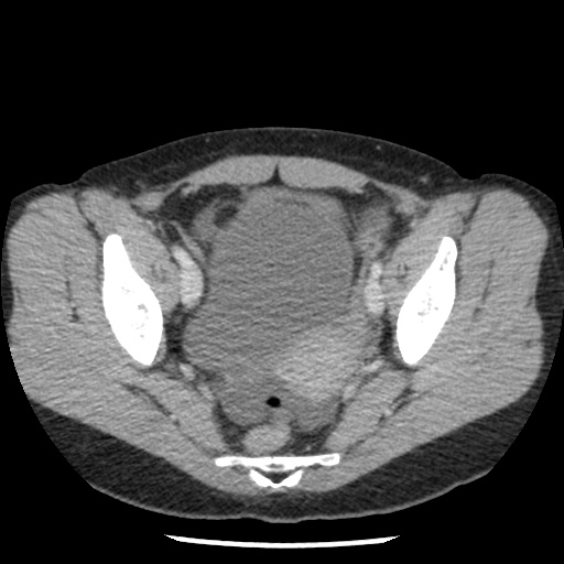Closed loop small bowel obstruction due to trans-omental herniation (Radiopaedia 35593-37109 A 74).jpg