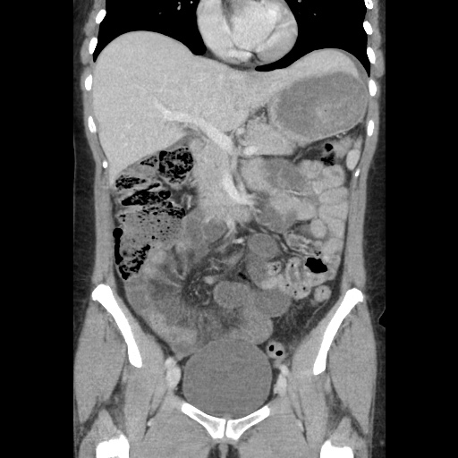 File:Closed loop small bowel obstruction due to trans-omental herniation (Radiopaedia 35593-37109 B 25).jpg