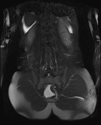 File:Closed loop small bowel obstruction in pregnancy (MRI) (Radiopaedia 87637-104031 Coronal T2 fat sat 45).jpg