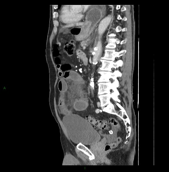 Closed loop small bowel obstruction with ischemia (Radiopaedia 84180-99456 C 53).jpg
