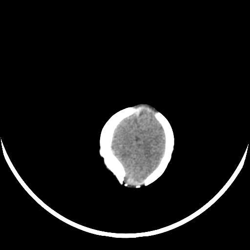 File:Cloverleaf shaped skull in the absence of craniosynostosis (Radiopaedia 21296-21216 Axial non-contrast 19).jpg