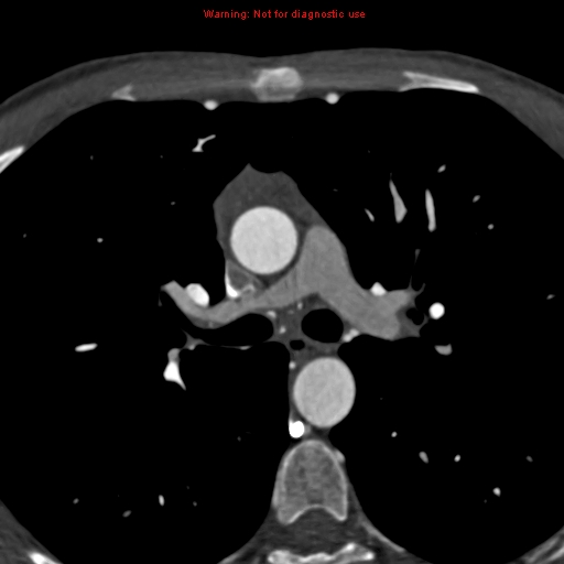 File:Coarctation of the aorta (Radiopaedia 12461-12697 A 175).jpg