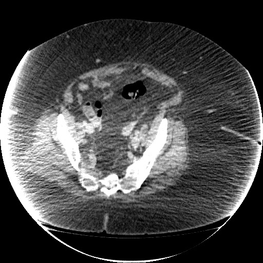 File:Collection due to leak after sleeve gastrectomy (Radiopaedia 55504-61972 A 66).jpg