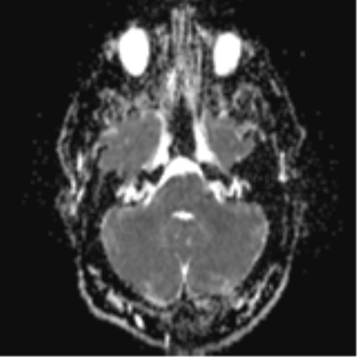File:Colloid cyst (Radiopaedia 44510-48181 Axial ADC 7).png
