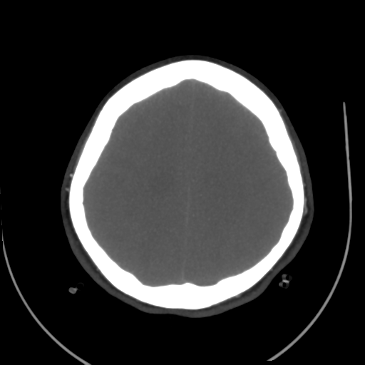 File:Colloid cyst (resulting in death) (Radiopaedia 33423-34499 A 44).png
